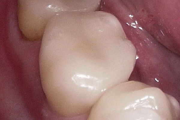 セレック治療による自然な仕上がり｜北九州市の歯科医｜あらたけ歯科クリニック