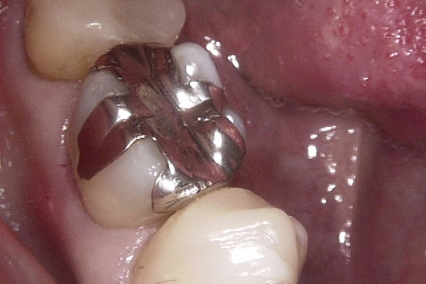 セレック治療の前の状態｜北九州市の歯科医｜あらたけ歯科クリニック