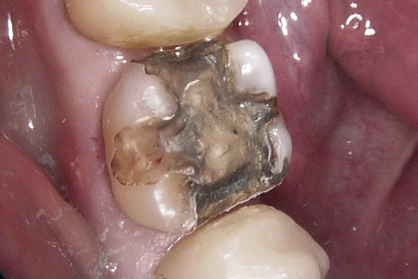 セレックによる治療中の状態｜北九州市の歯科医｜あらたけ歯科クリニック